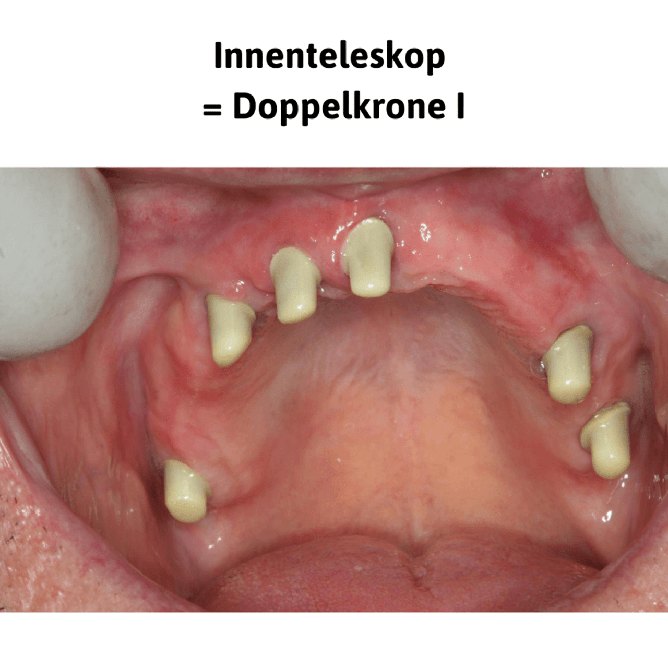 Innenteleskop = Doppelkrone I: Kronen auf den eigenen Zähnen