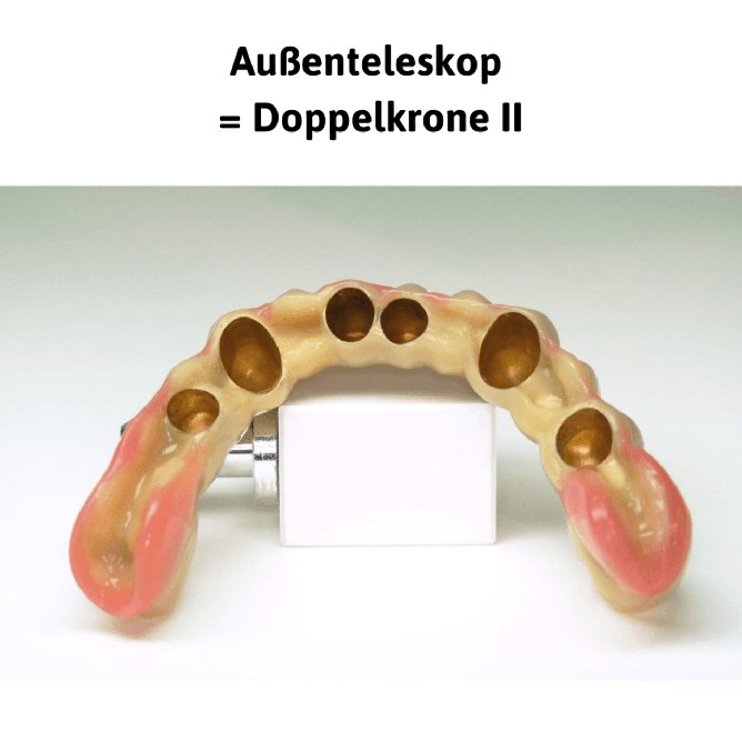 Außenteleskop = Doppelkrone II: die herausnehmbare Zahnreihe